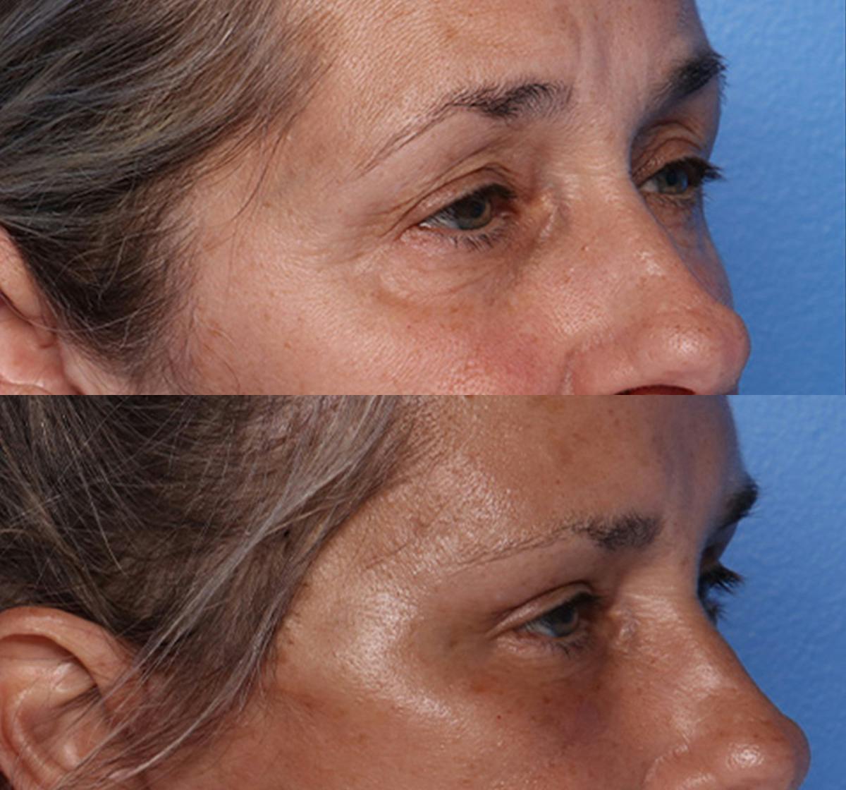 Brow Lift Before & After Gallery - Patient 177282 - Image 2