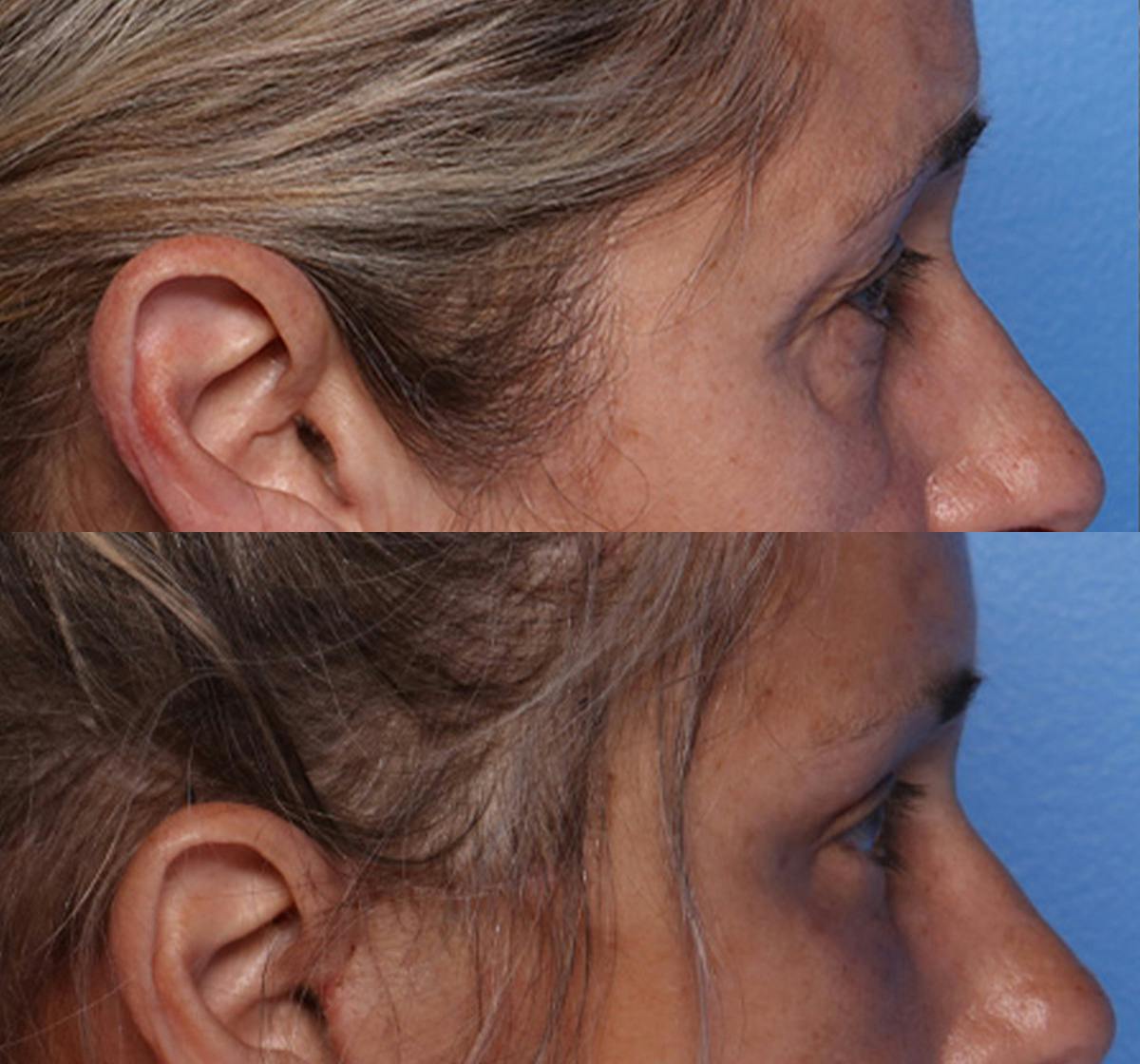 Brow Lift Before & After Gallery - Patient 177282 - Image 3