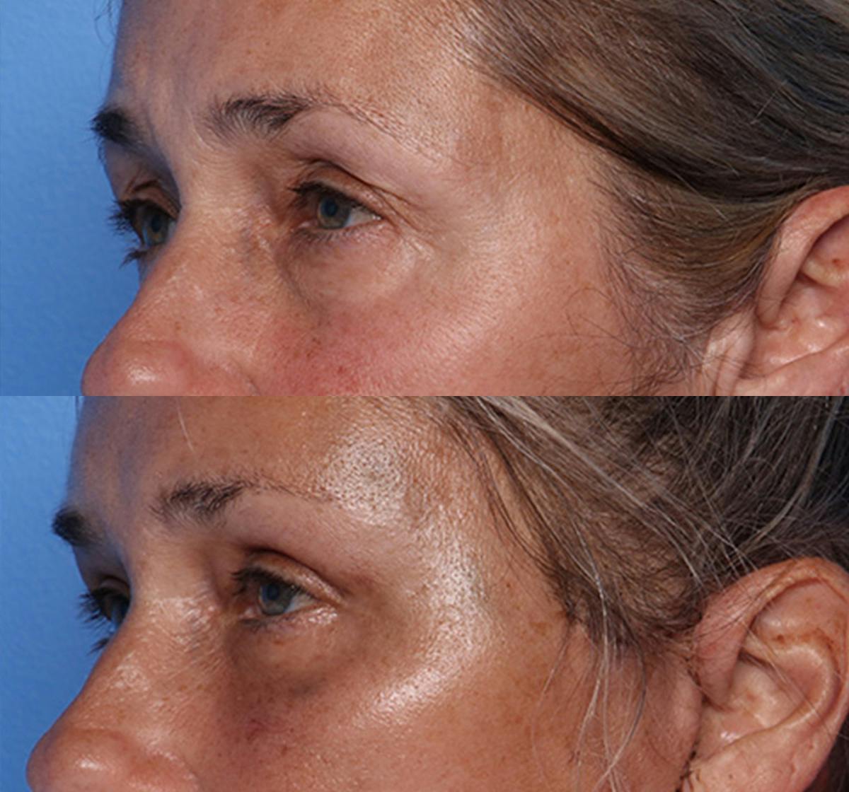 Brow Lift Before & After Gallery - Patient 177282 - Image 4