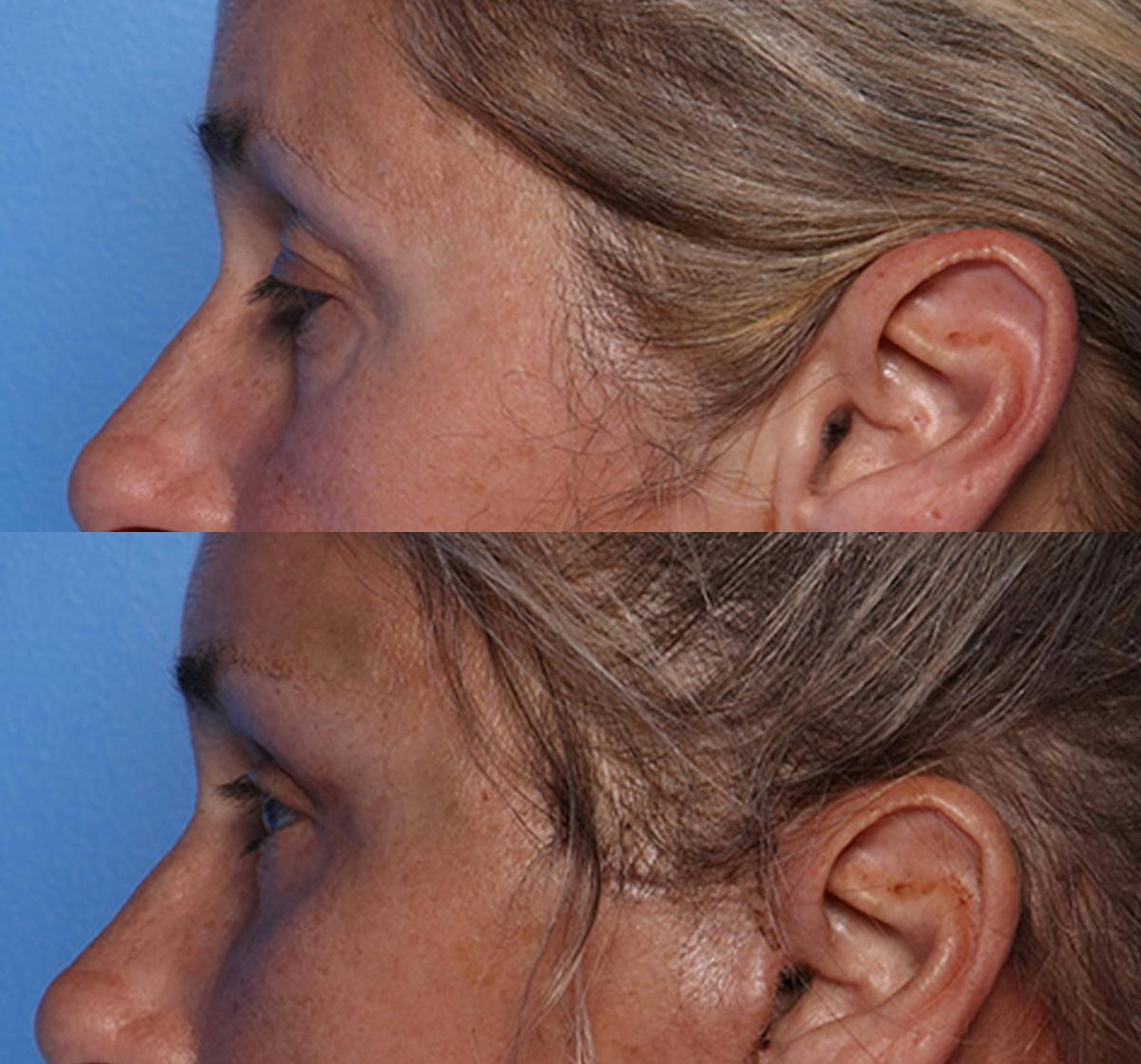 Brow Lift Before & After Gallery - Patient 177282 - Image 5