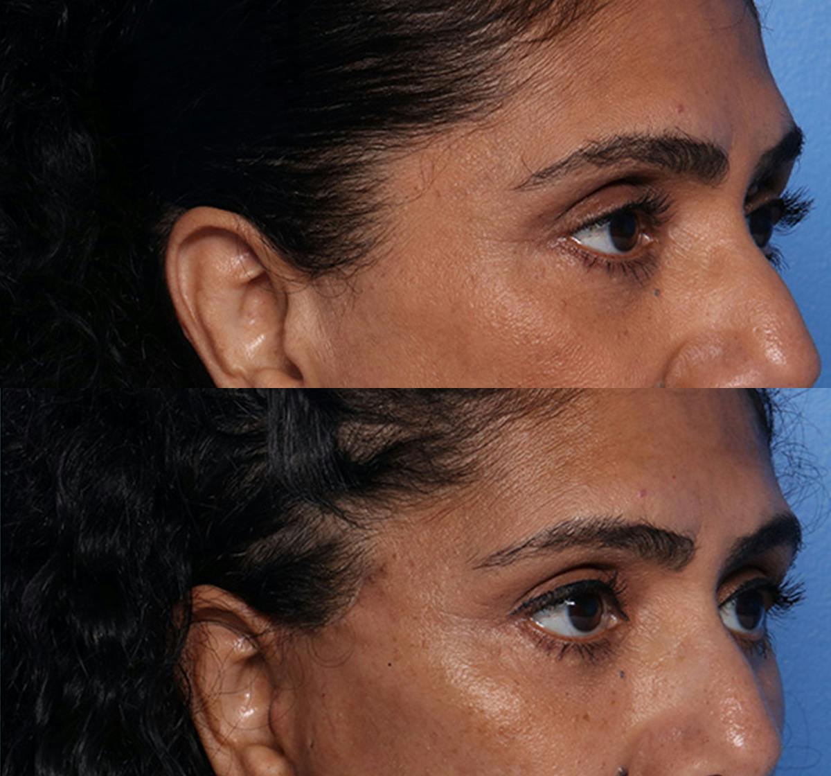 Brow Lift Before & After Gallery - Patient 294547 - Image 2