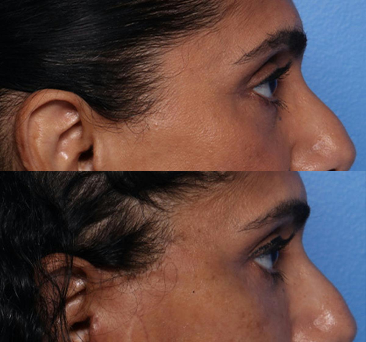 Brow Lift Before & After Gallery - Patient 294547 - Image 3