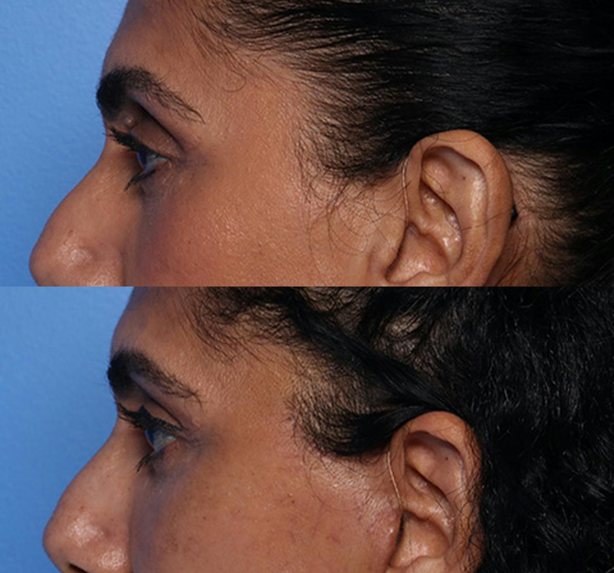 Brow Lift Before & After Gallery - Patient 294547 - Image 5