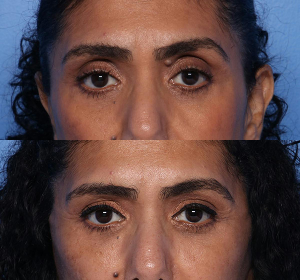 Brow Lift Before & After Gallery - Patient 294547 - Image 1