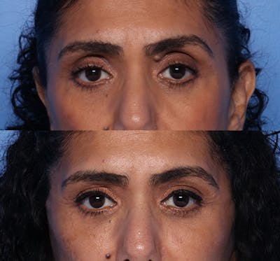 Brow Lift Before & After Gallery - Patient 294547 - Image 1