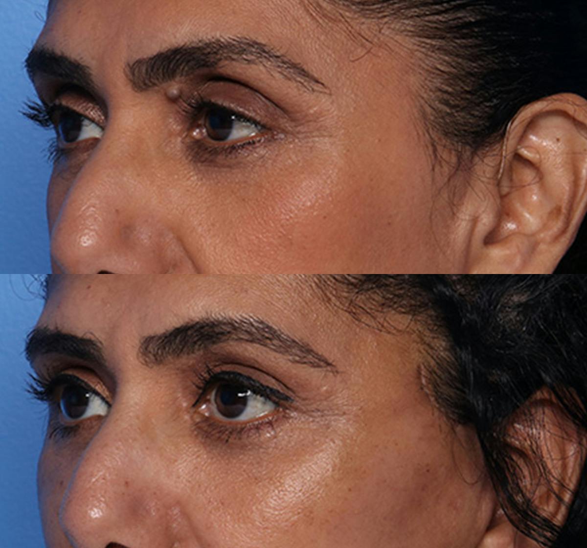 Brow Lift Before & After Gallery - Patient 294547 - Image 4