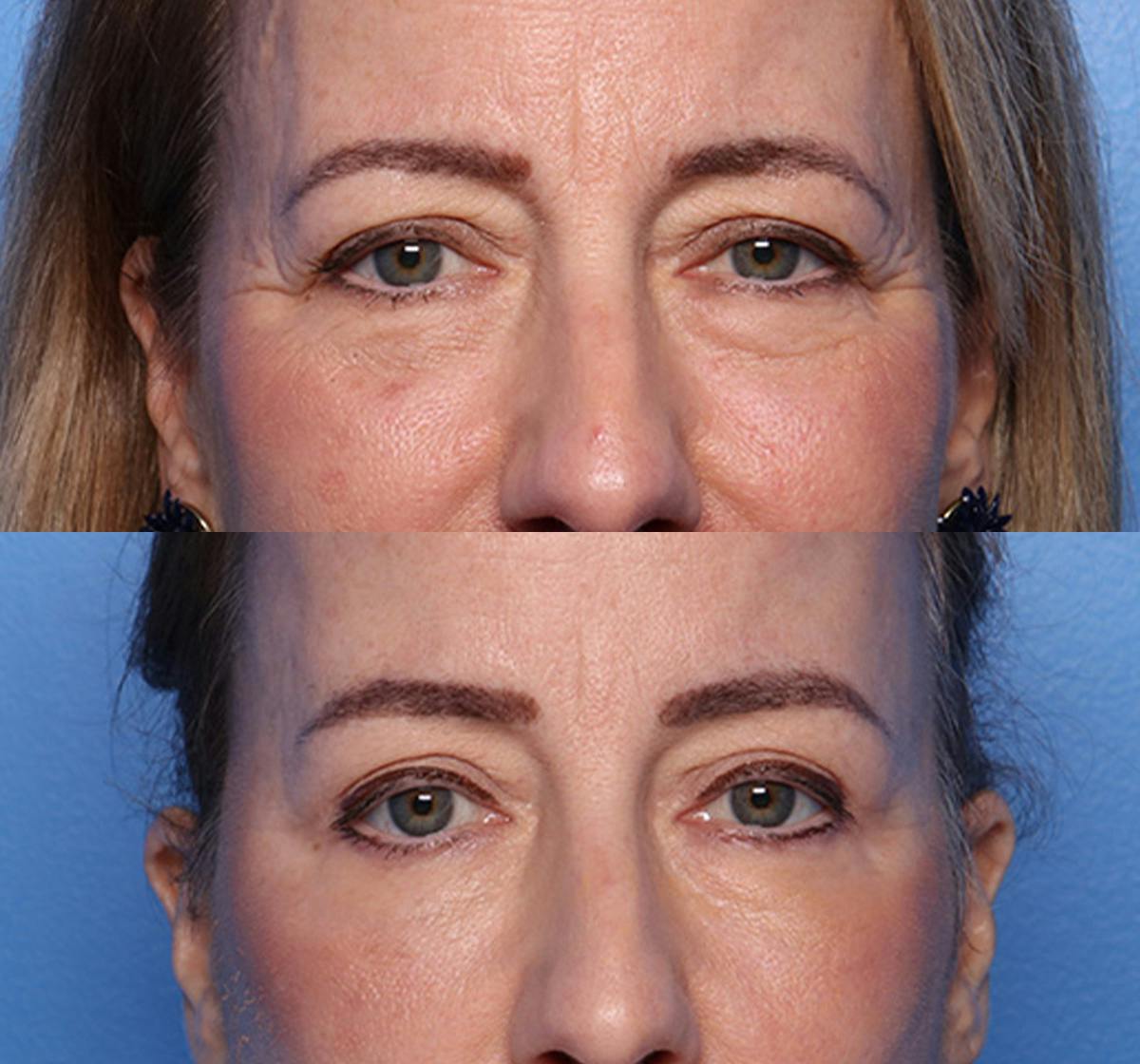 Brow Lift Before & After Gallery - Patient 233463 - Image 1