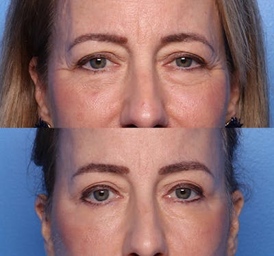Brow Lift Before & After Gallery - Patient 233463 - Image 1