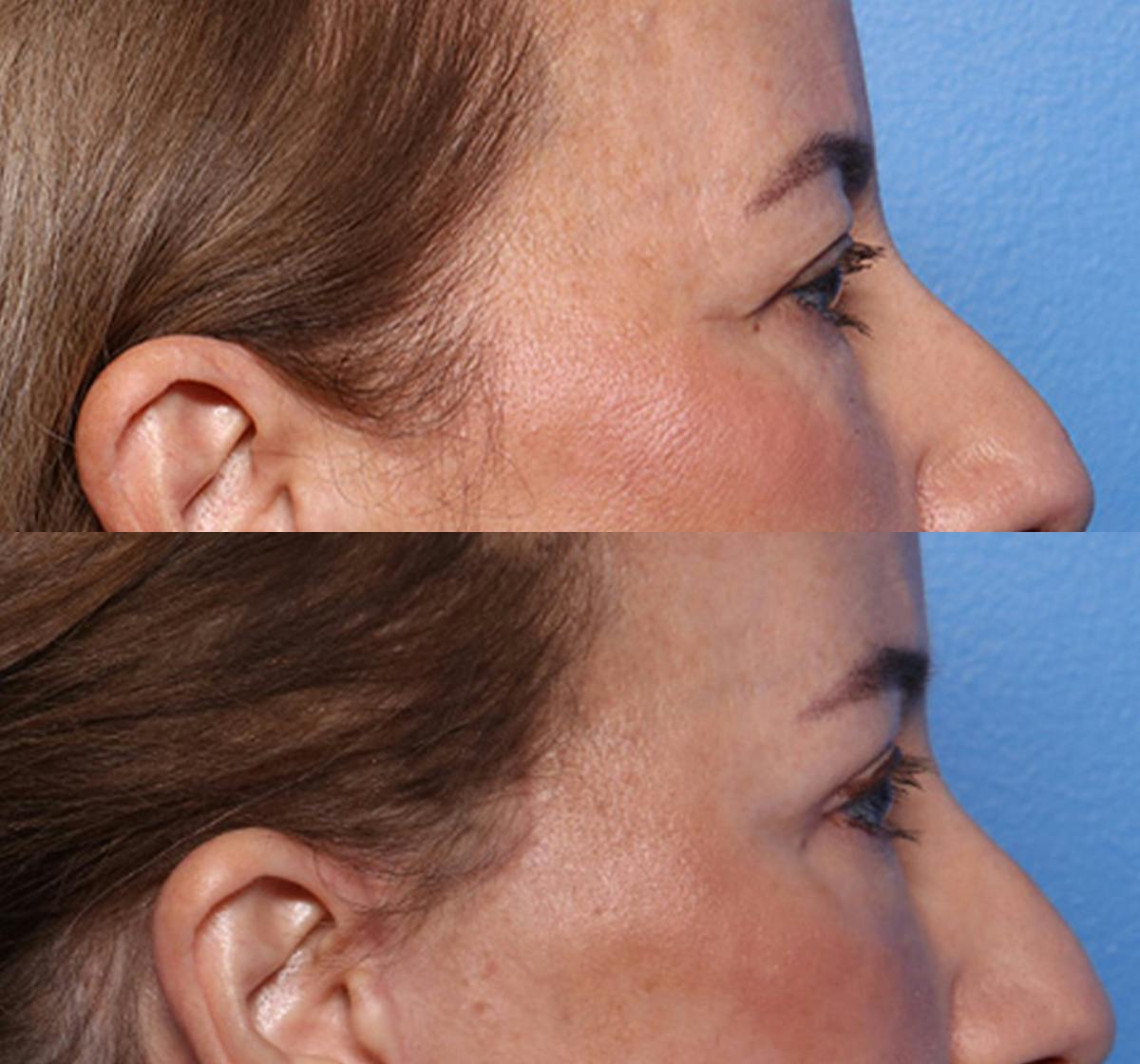 Brow Lift Before & After Gallery - Patient 233463 - Image 2