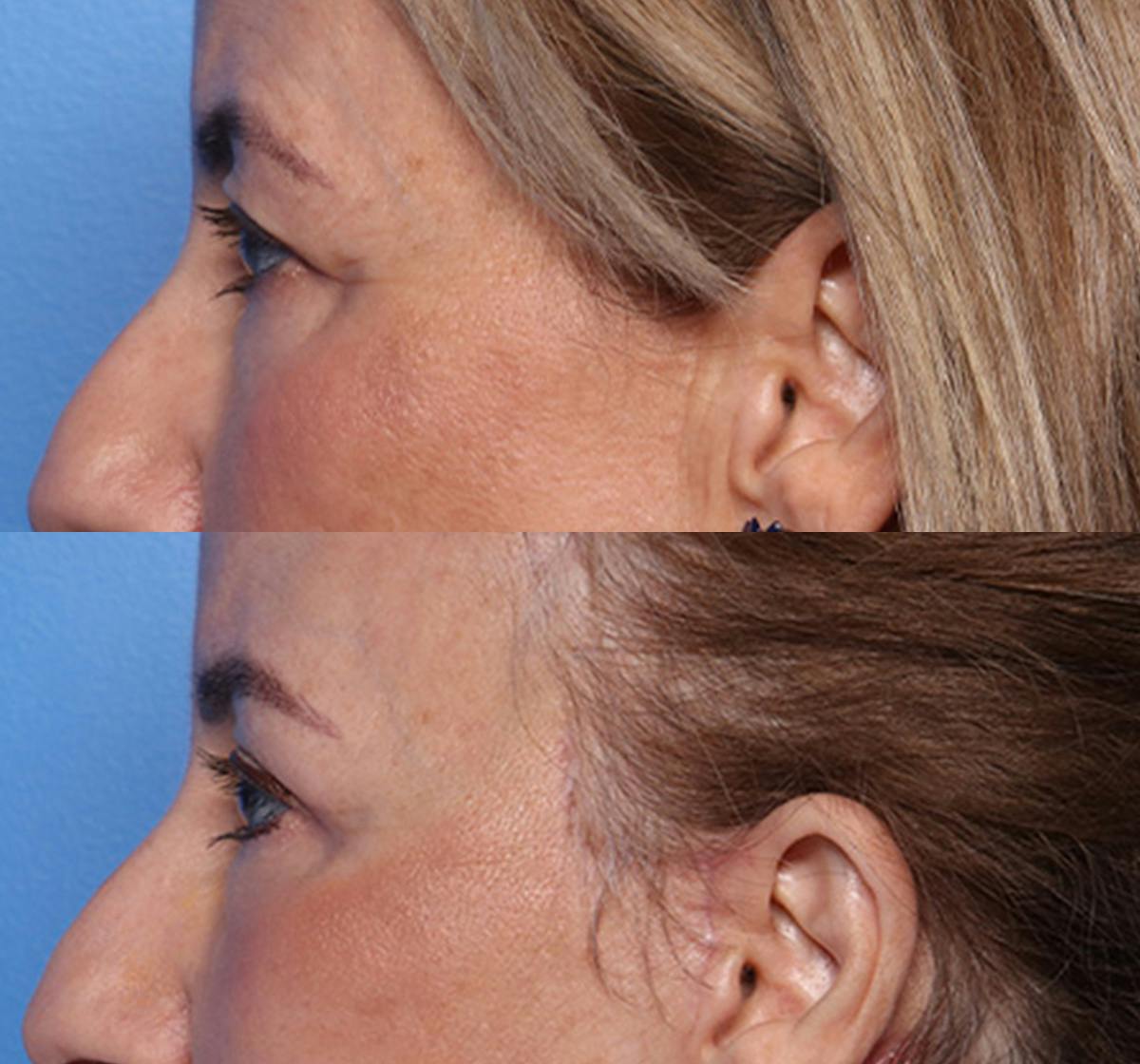 Brow Lift Before & After Gallery - Patient 233463 - Image 3