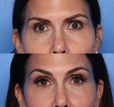 Brow Lift Before & After Gallery - Patient 469046 - Image 1