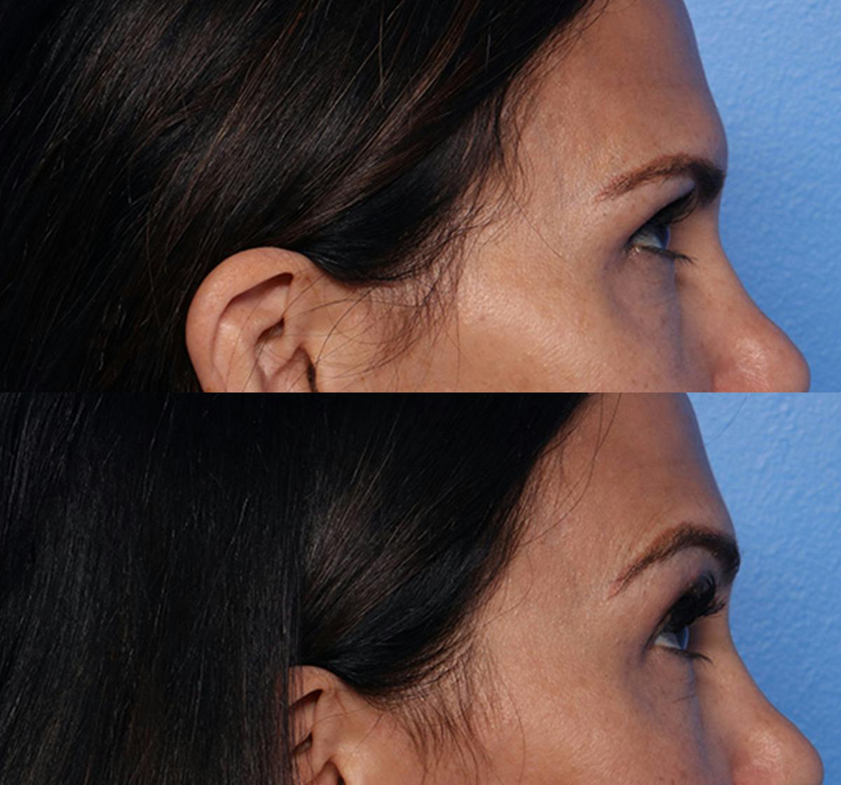 Brow Lift Before & After Gallery - Patient 469046 - Image 3