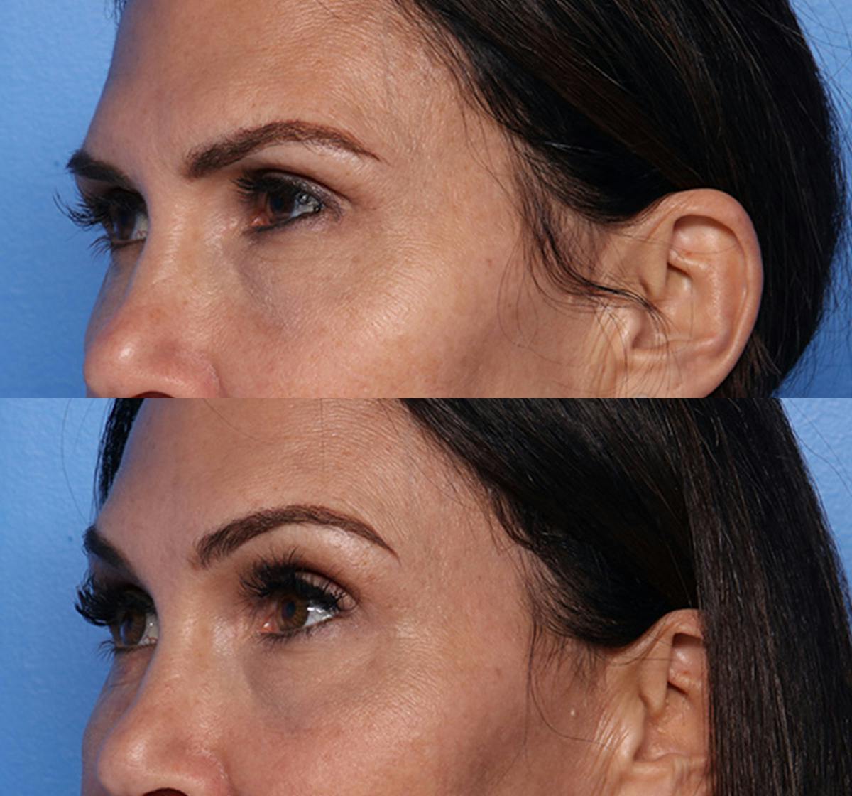 Brow Lift Before & After Gallery - Patient 469046 - Image 4