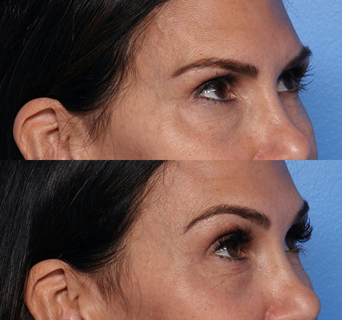Brow Lift Before & After Gallery - Patient 469046 - Image 2