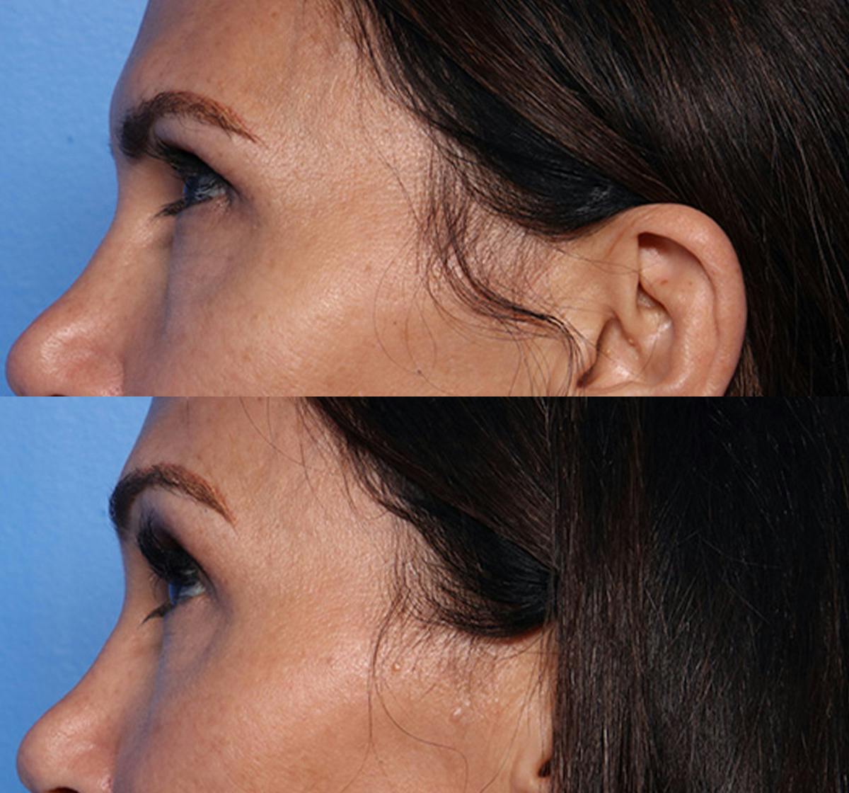 Brow Lift Before & After Gallery - Patient 469046 - Image 5