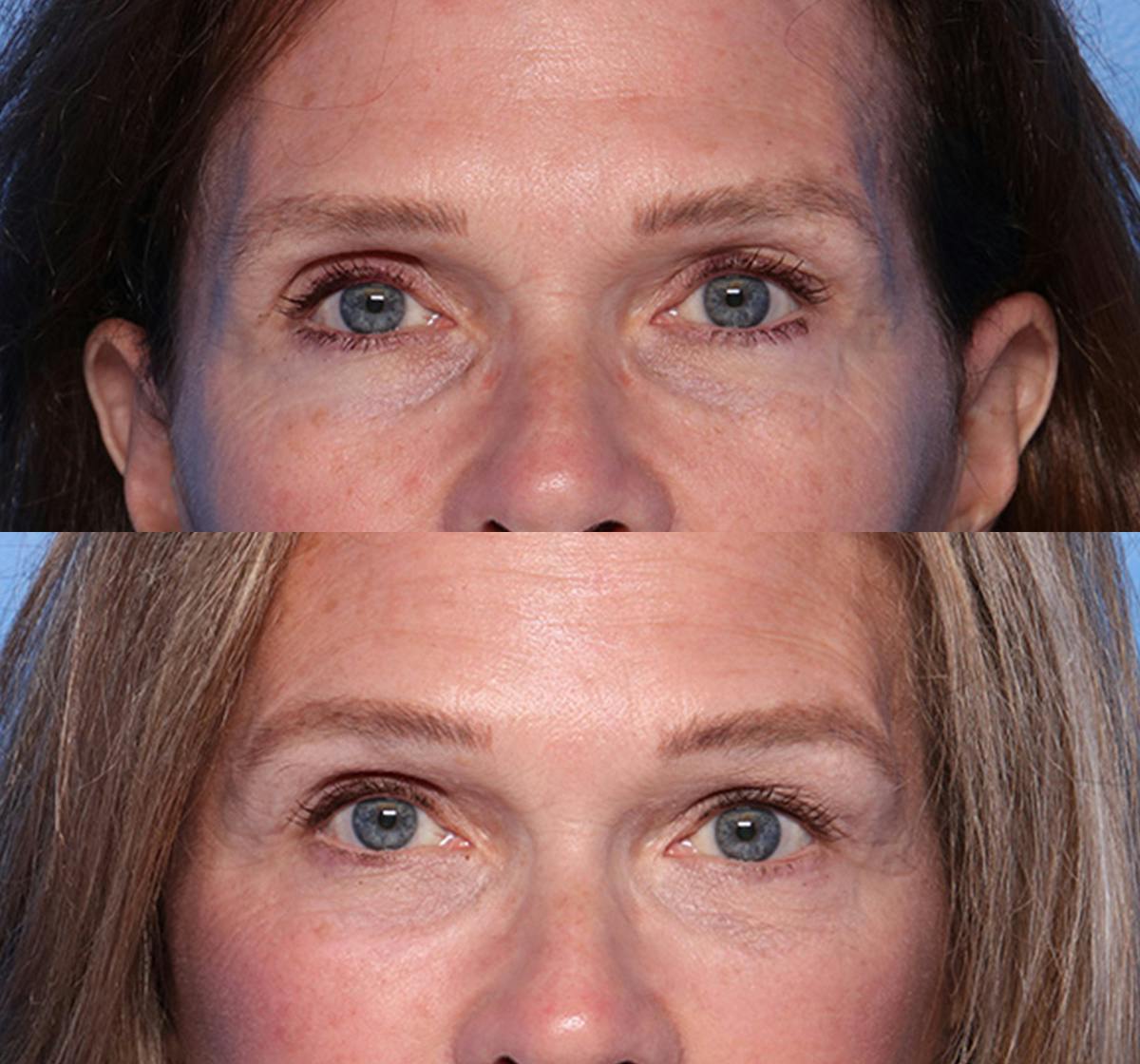 Brow Lift Before & After Gallery - Patient 346740 - Image 1