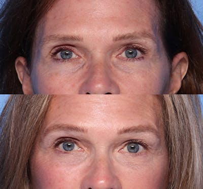 Brow Lift Before & After Gallery - Patient 346740 - Image 1