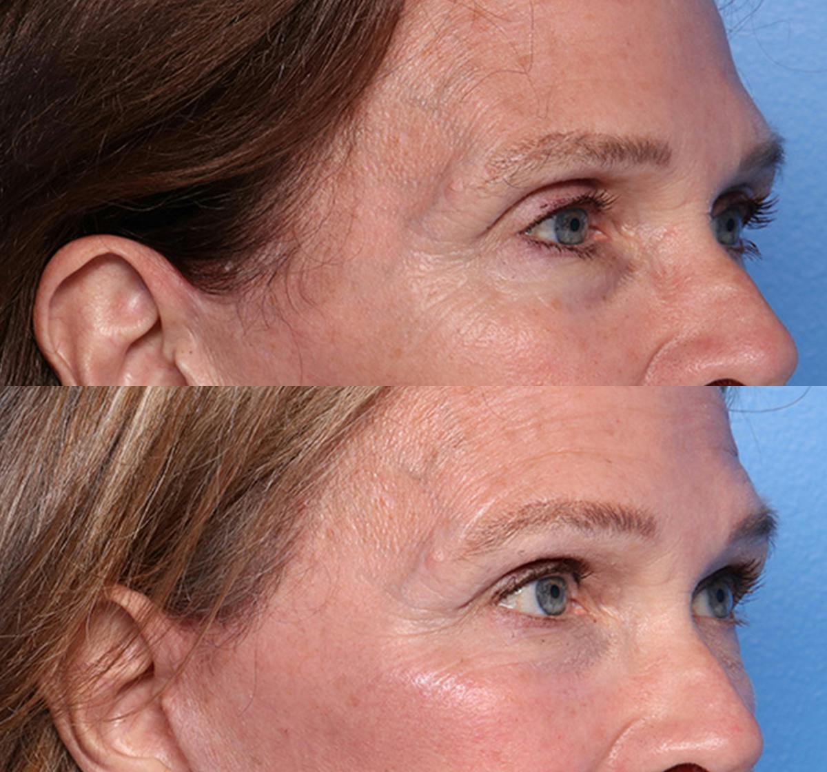 Brow Lift Before & After Gallery - Patient 346740 - Image 2