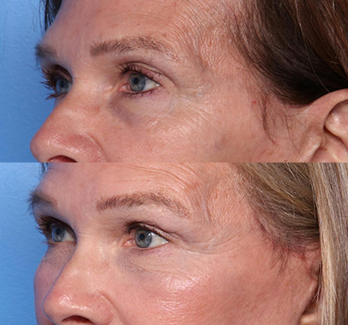 Brow Lift Before & After Gallery - Patient 346740 - Image 3