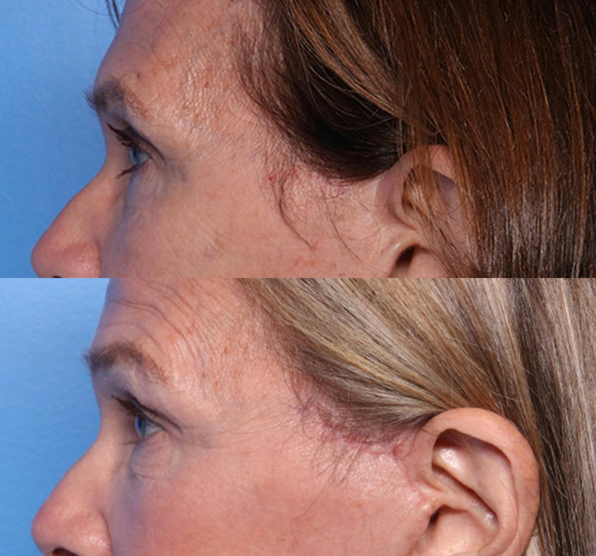 Brow Lift Before & After Gallery - Patient 346740 - Image 4