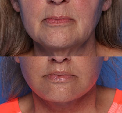 Lip Lift Before & After Gallery - Patient 429325 - Image 1