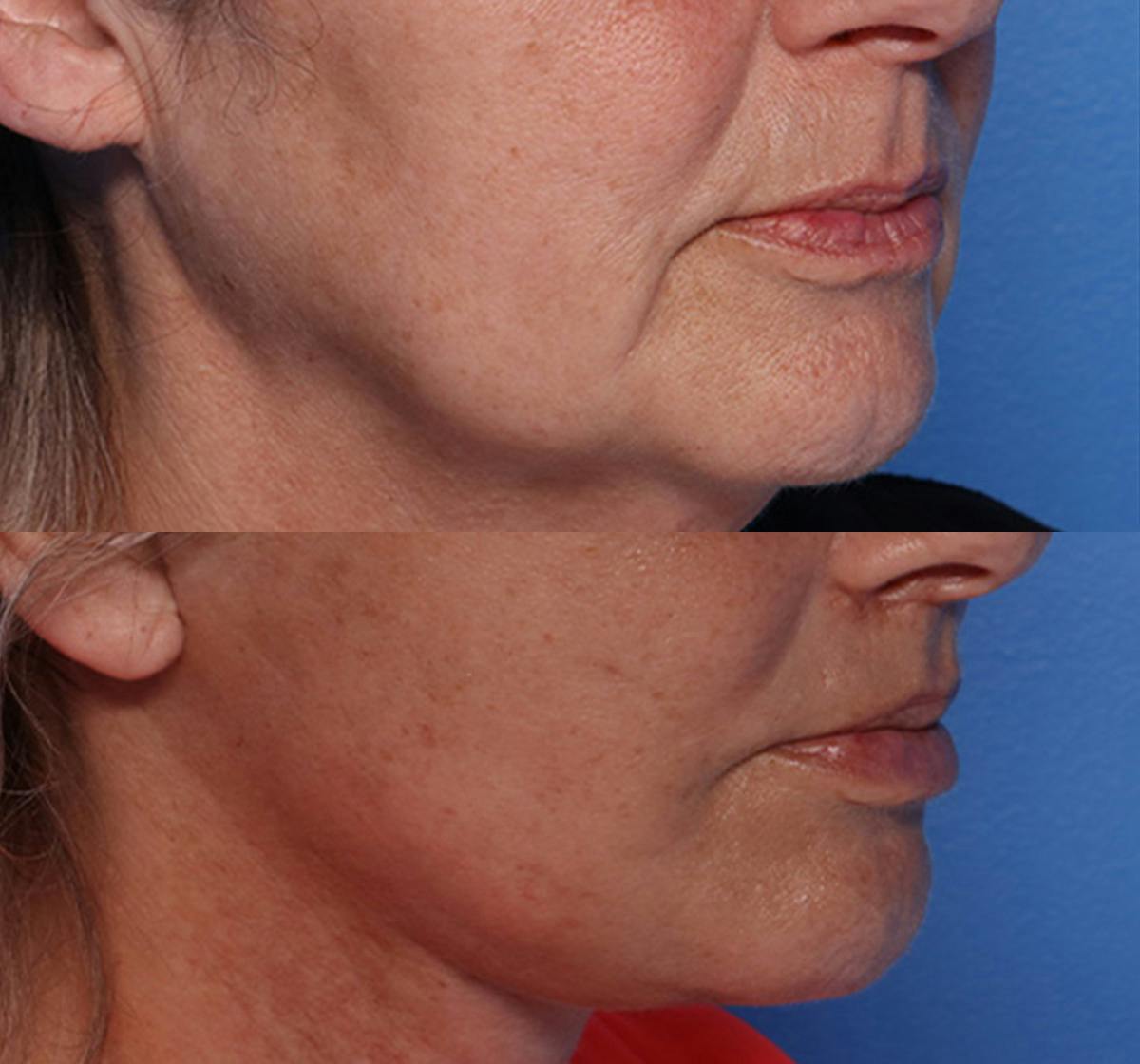 Lip Lift Before & After Gallery - Patient 429325 - Image 2