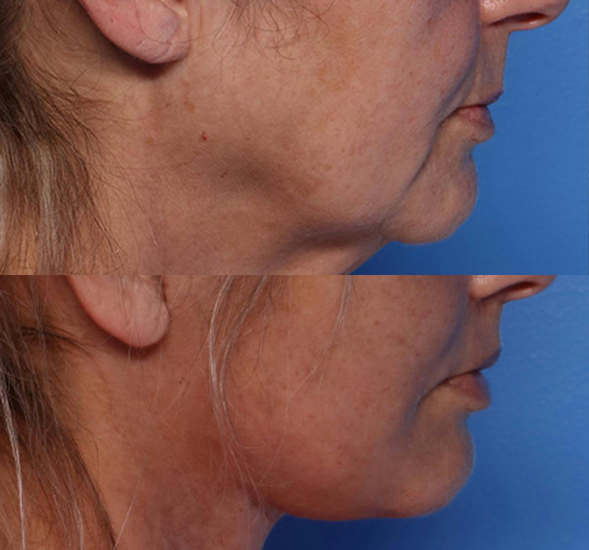 Lip Lift Before & After Gallery - Patient 429325 - Image 3
