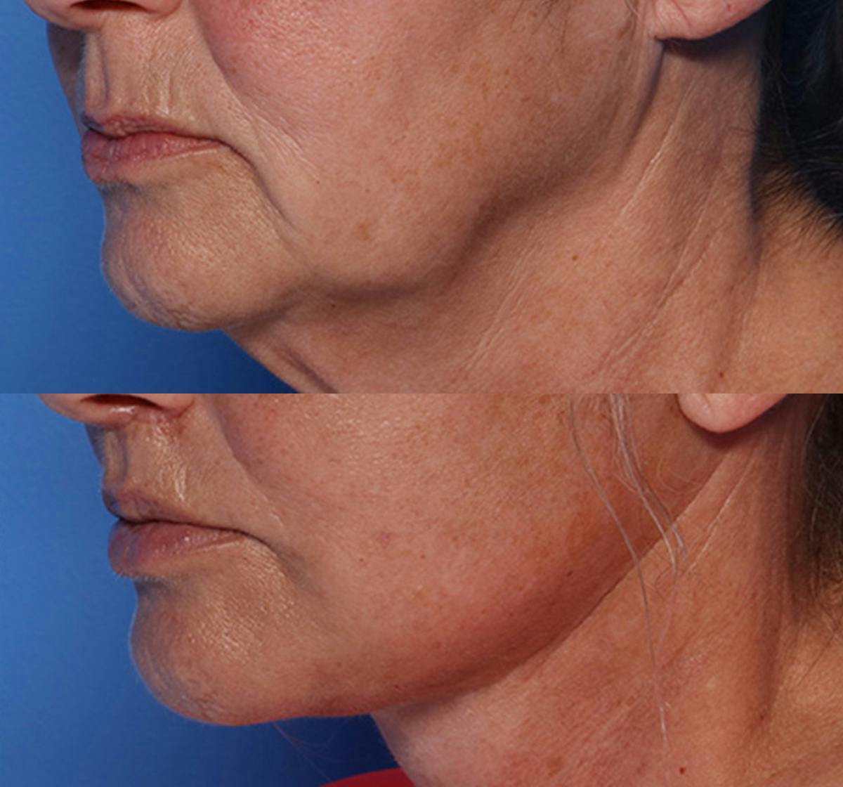 Lip Lift Before & After Gallery - Patient 429325 - Image 4