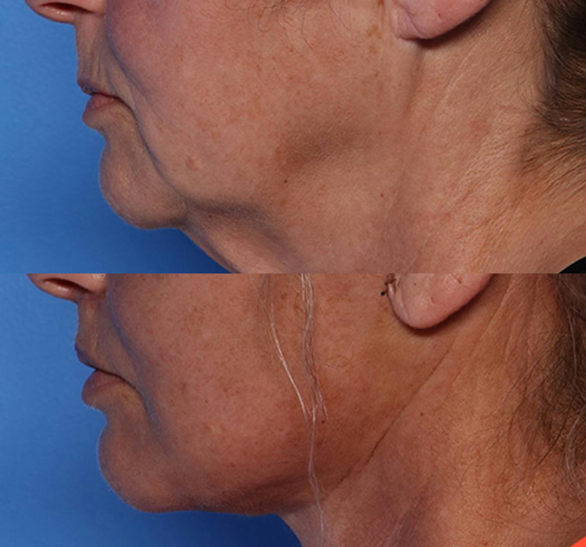 Lip Lift Before & After Gallery - Patient 429325 - Image 5