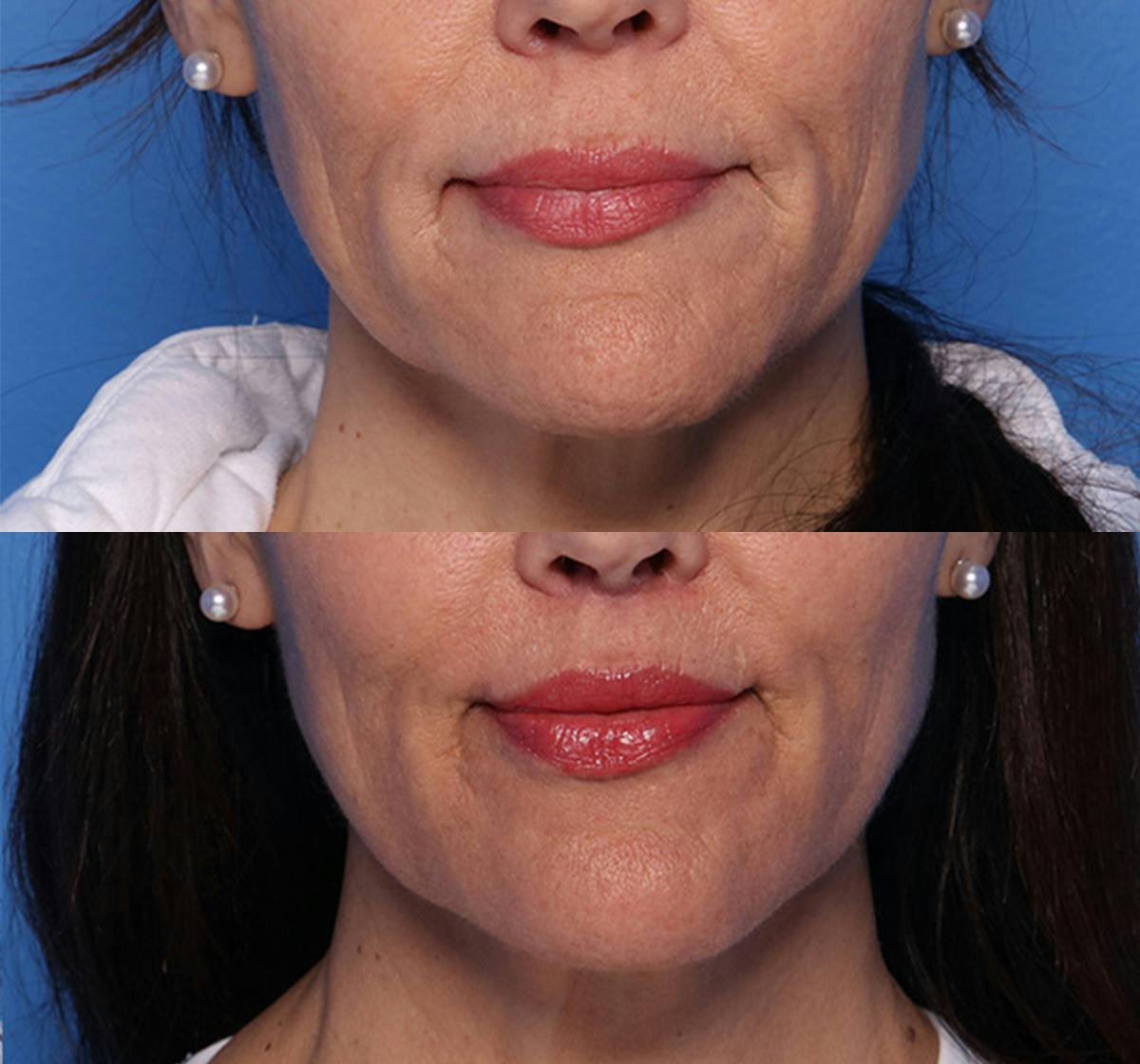 Lip Lift Before & After Gallery - Patient 466009 - Image 1