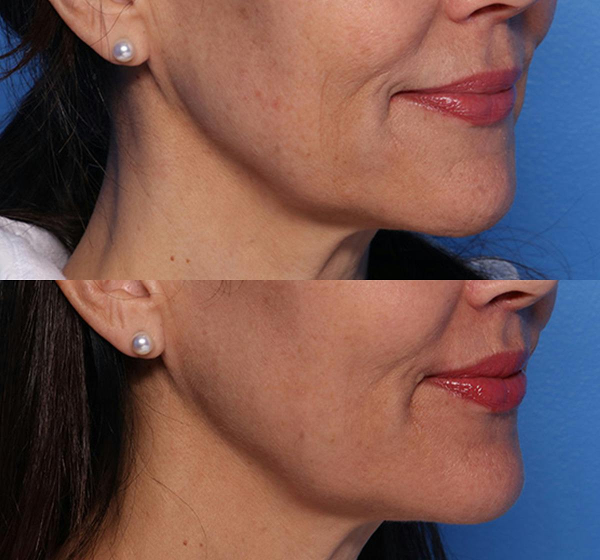 Lip Lift Before & After Gallery - Patient 466009 - Image 2