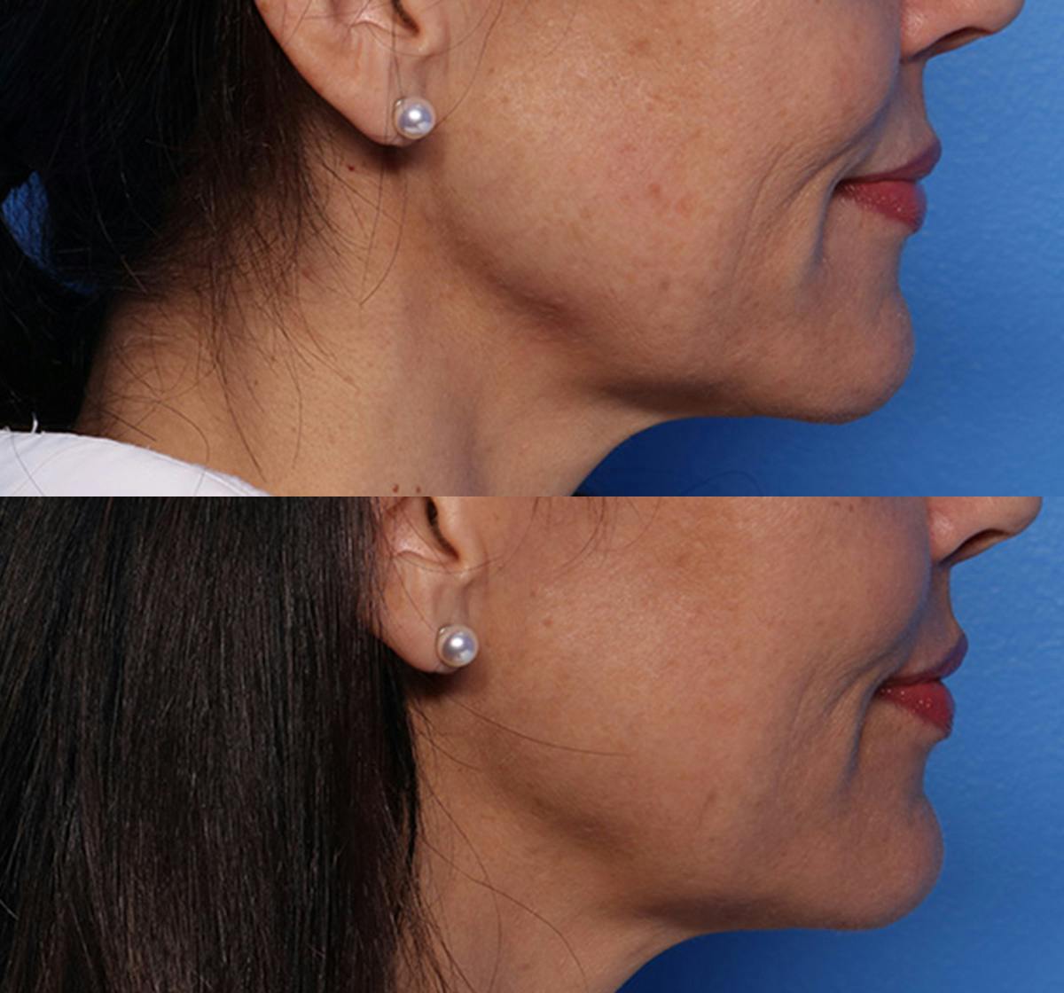 Lip Lift Before & After Gallery - Patient 466009 - Image 3