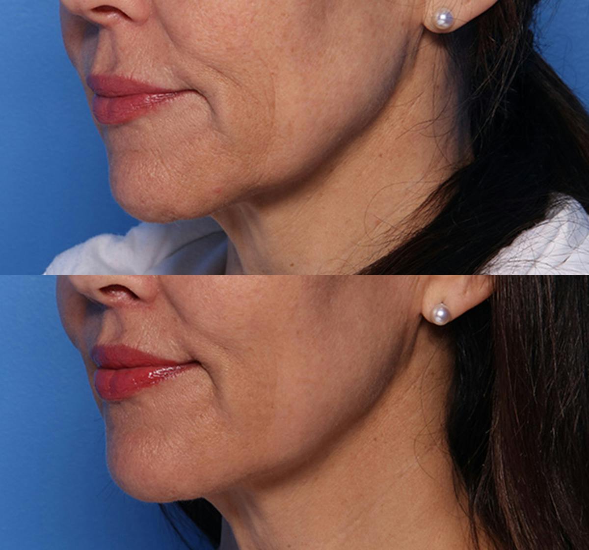 Lip Lift Before & After Gallery - Patient 466009 - Image 4