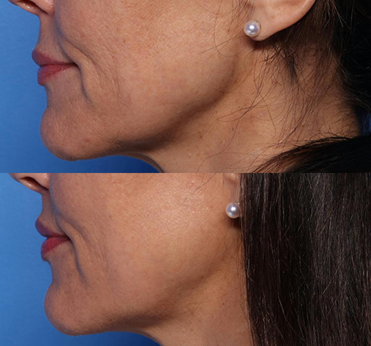 Lip Lift Before & After Gallery - Patient 466009 - Image 5