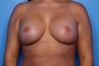 Liposuction Before & After Gallery - Patient 391900 - Image 2