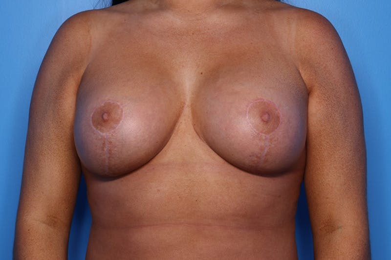 Liposuction Before & After Gallery - Patient 391900 - Image 2