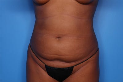 Liposuction Before & After Gallery - Patient 223016 - Image 1