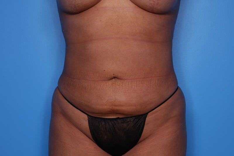 Liposuction Before & After Gallery - Patient 223016 - Image 2