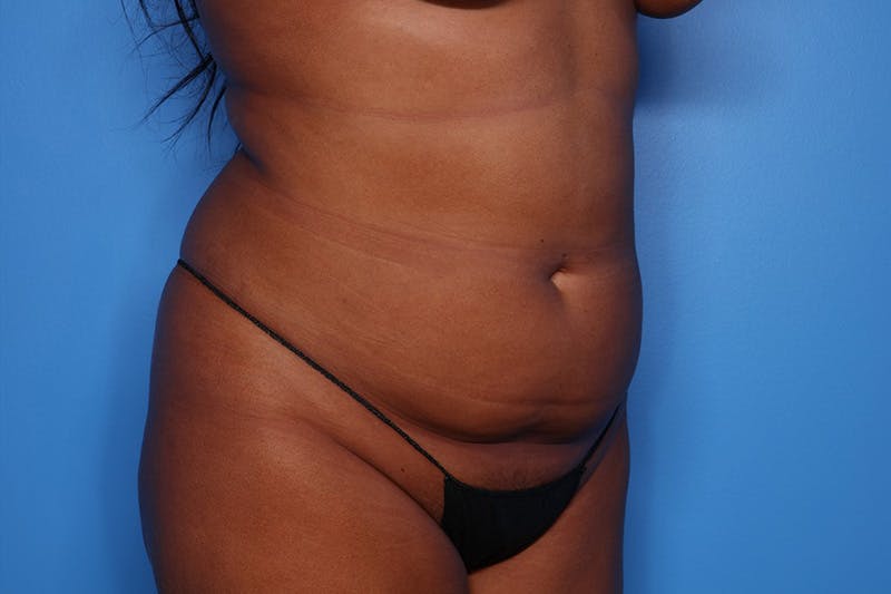 Liposuction Before & After Gallery - Patient 223016 - Image 3