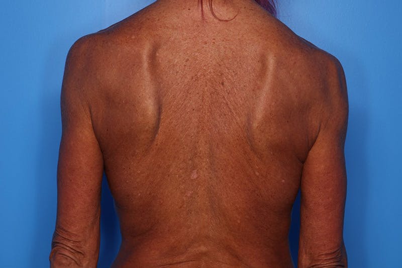Body Lift Before & After Gallery - Patient 282681 - Image 3