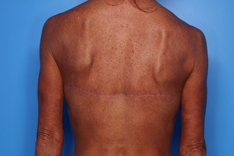 Body Lift Before & After Gallery - Patient 282681 - Image 4