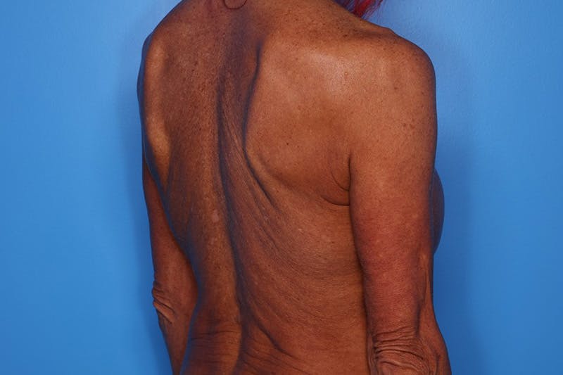 Body Lift Before & After Gallery - Patient 282681 - Image 5