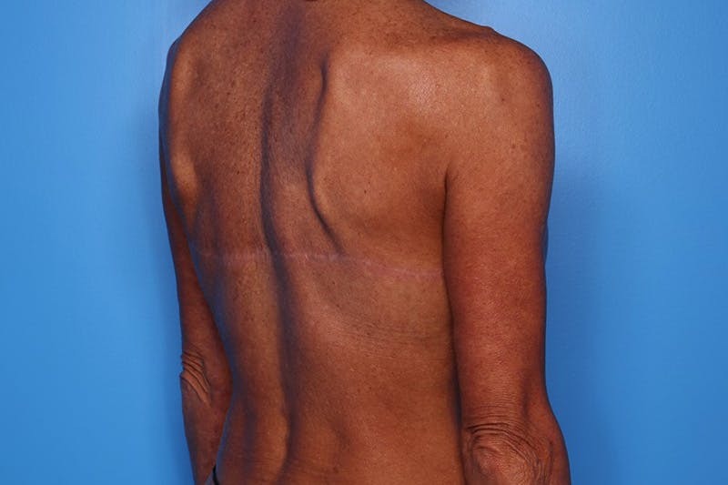 Body Lift Before & After Gallery - Patient 282681 - Image 6