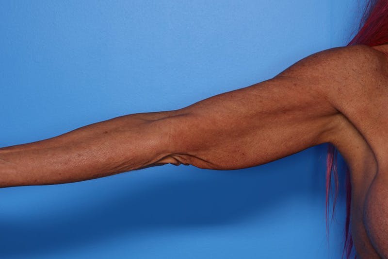 Body Lift Before & After Gallery - Patient 282681 - Image 7
