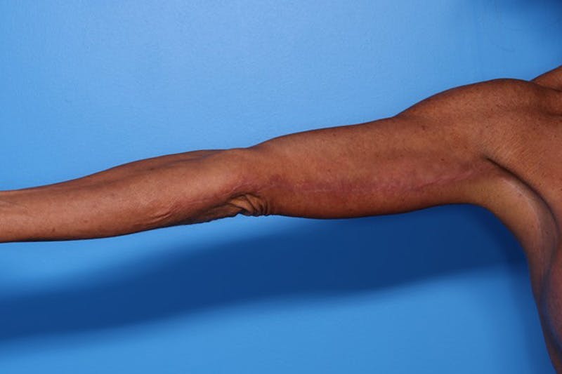 Body Lift Before & After Gallery - Patient 282681 - Image 8