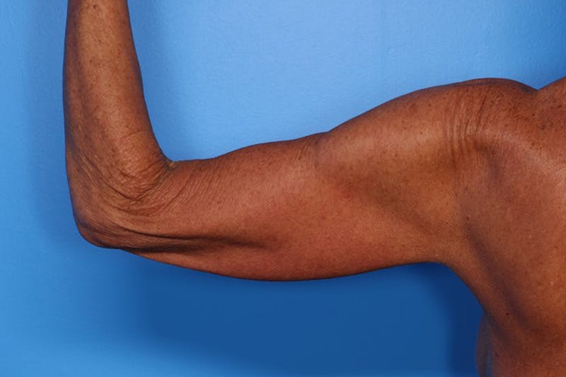 Body Lift Before & After Gallery - Patient 282681 - Image 11