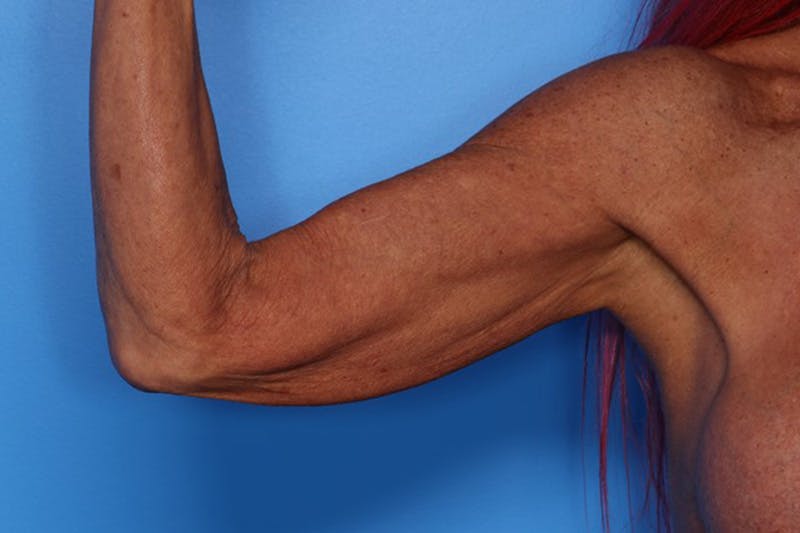 Body Lift Before & After Gallery - Patient 282681 - Image 9