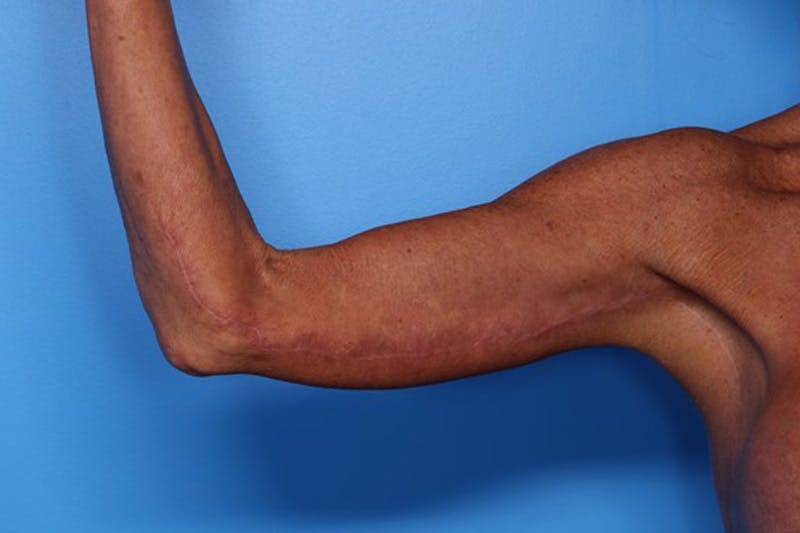 Body Lift Before & After Gallery - Patient 282681 - Image 10