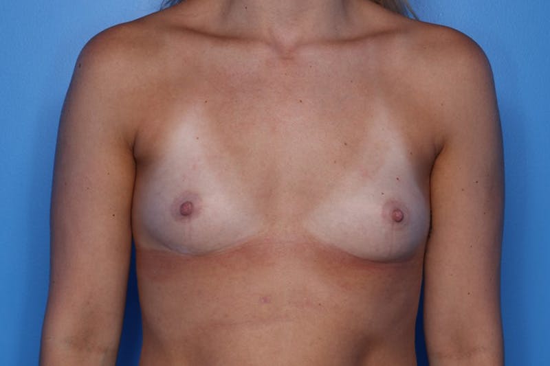 Breast Augmentation Before & After Gallery - Patient 976818 - Image 1