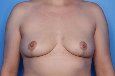 Breast Reduction Before & After Gallery - Patient 192811 - Image 1